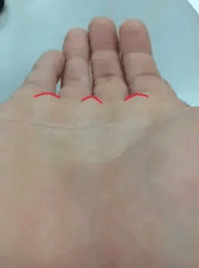 指と指の間の丘が膨れている